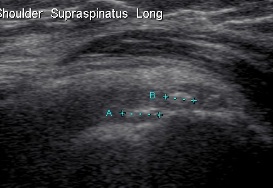 Ultrasound Calcium Supraspinatous